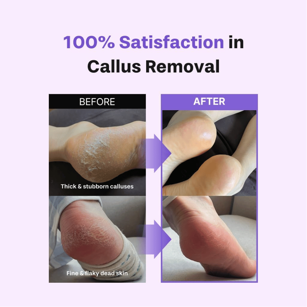 Pred in po uporabi kompleta BAREN Foot Callus Eraser Home Set na suhih stopalih, odmrli koži in otiščancih